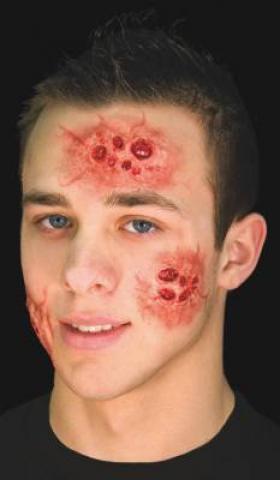 Special Effects - Facial Blisters